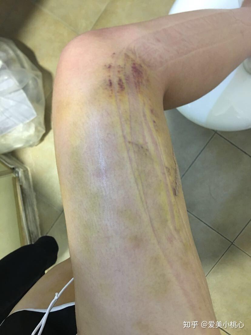 磨人的淤青吓得我都以为自己要失败了这都已经是快要恢复的时候关于后