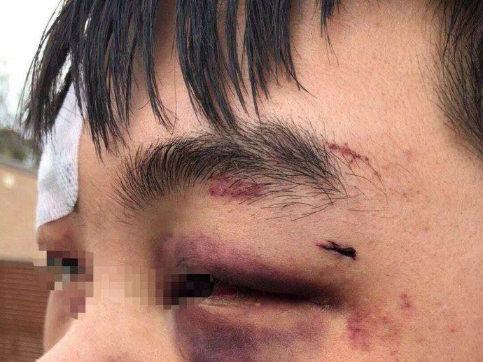 澳大利亚中国留学生遭暴力殴打首都华人自发开车护送同胞