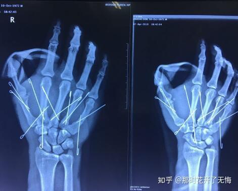 韩德君掌骨骨折属于什么类型,怎么治疗?什么时候能回归? - 知乎