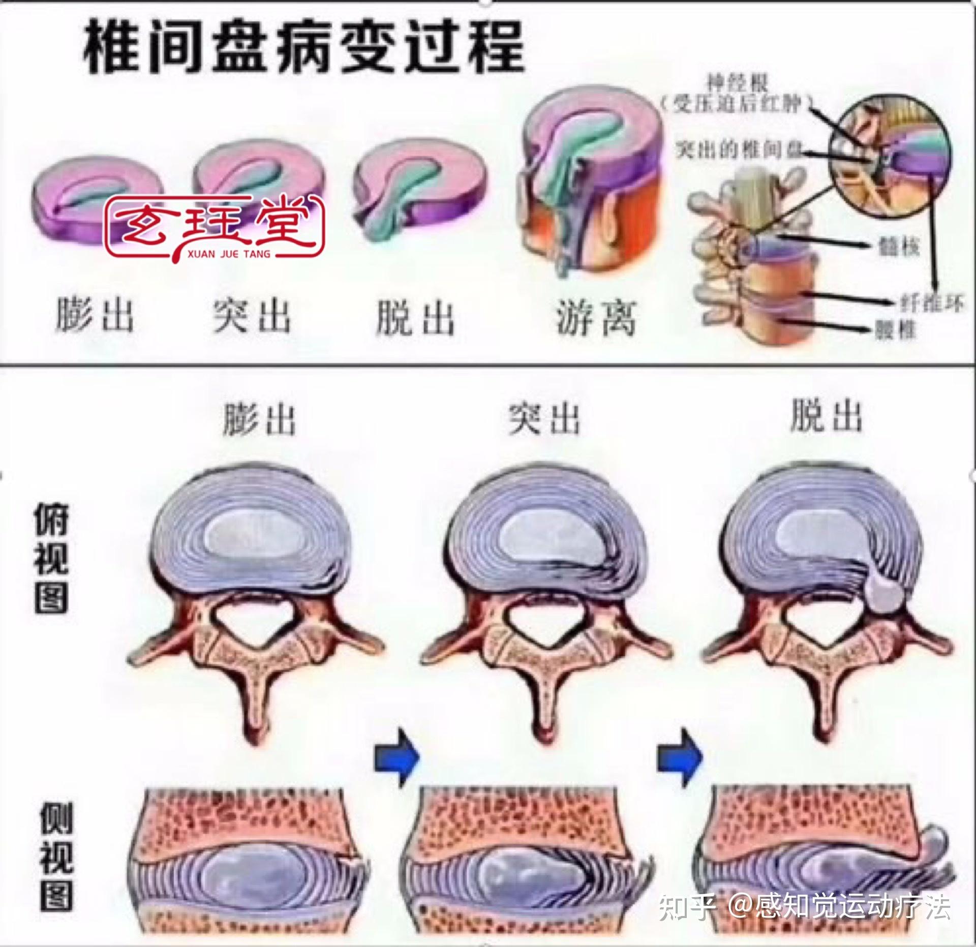 就是突出的腰椎间盘复位了吗?