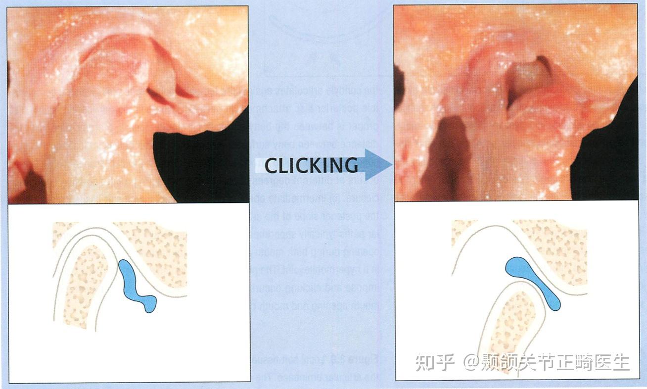 正常髁突图片