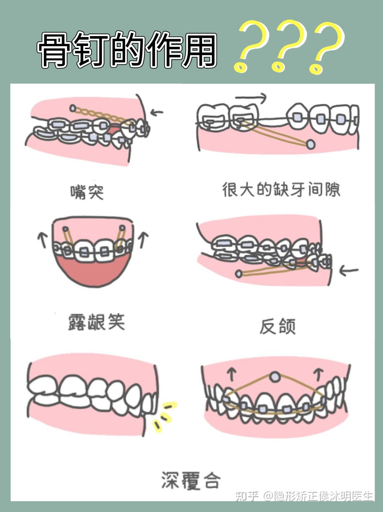 5,直立个别牙齿:骨钉可辅助直立严重倾斜的牙齿;4,压低后牙:常见于