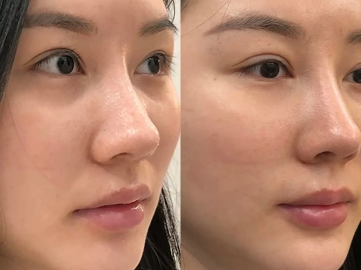 欧洲之星fotona4d多少钱欧洲之星效果如何做欧洲之星值得吗