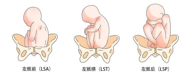 胎先露的六种方位图图片