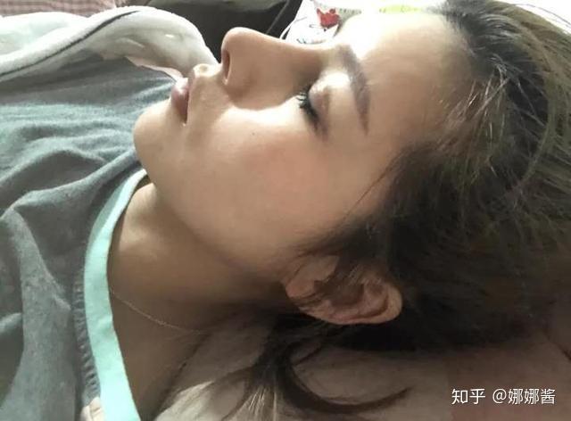 深圳女耳软骨隆鼻术后恢复效果鼻头和鼻根衔接的很好