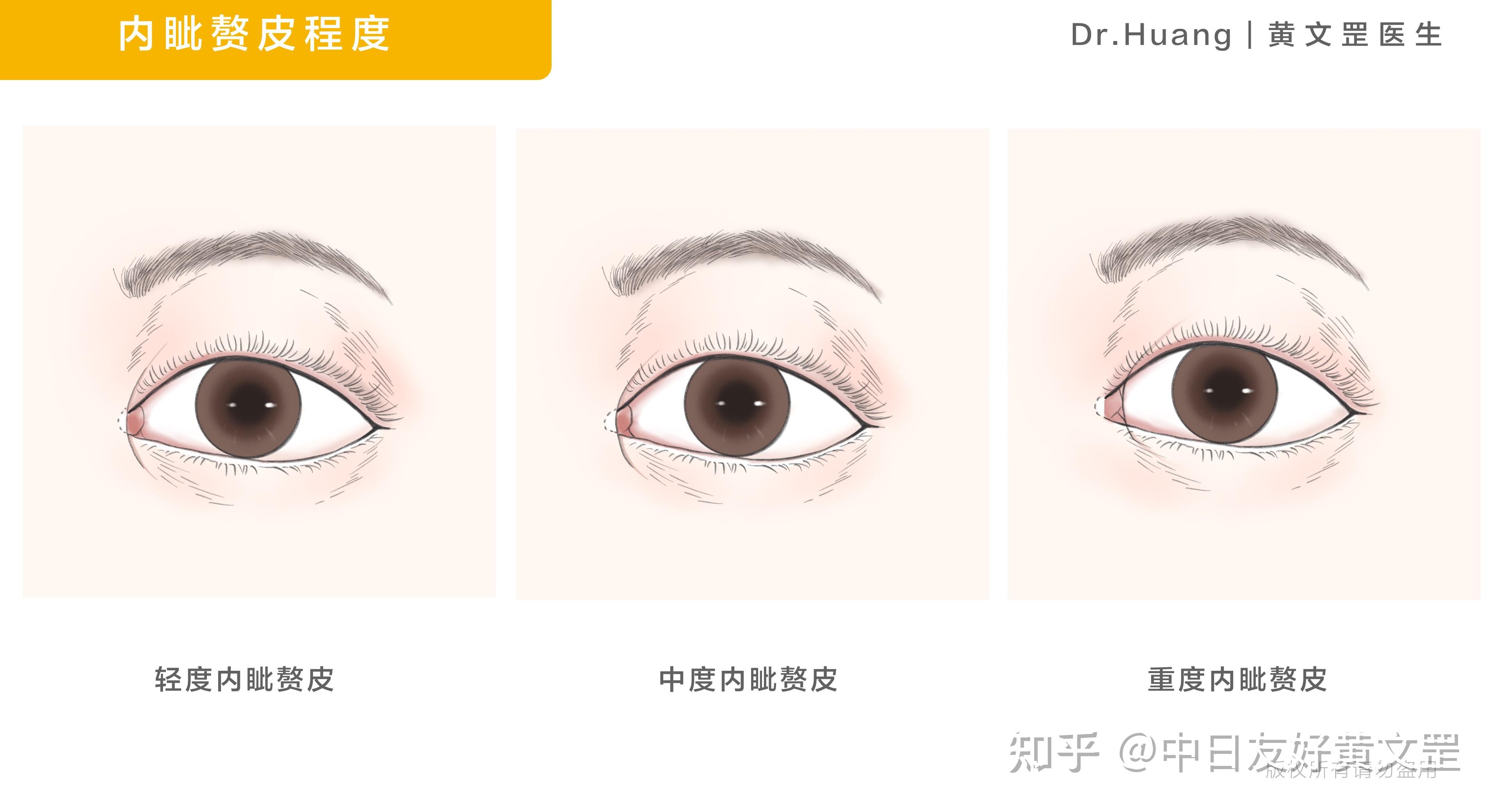 内眦赘皮怎么办图片