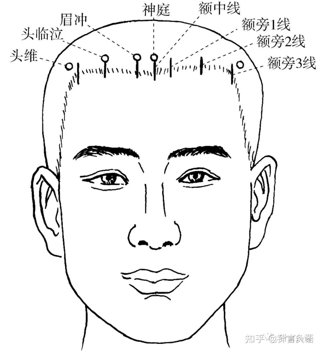 头部针灸运动区图图片