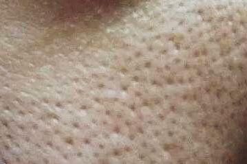 怎么解决毛孔粗 v2-d7b937bd734046e209c611c892804cfd_b.jpg