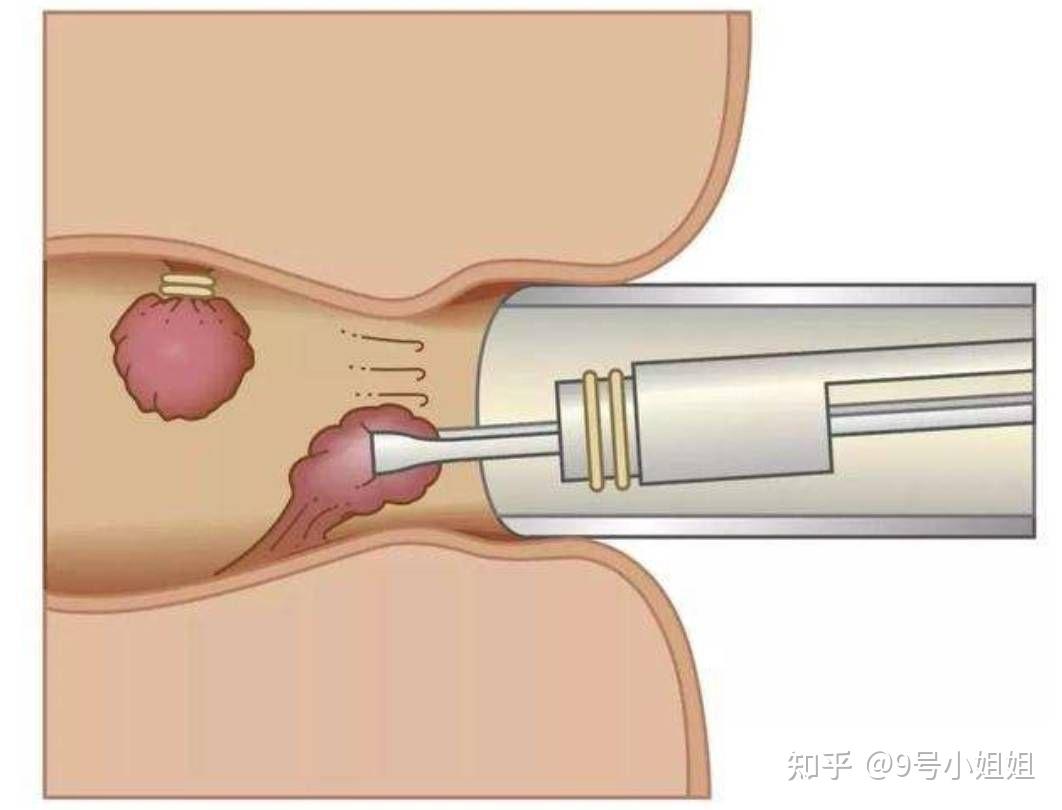 痔疮手术多长时间图片