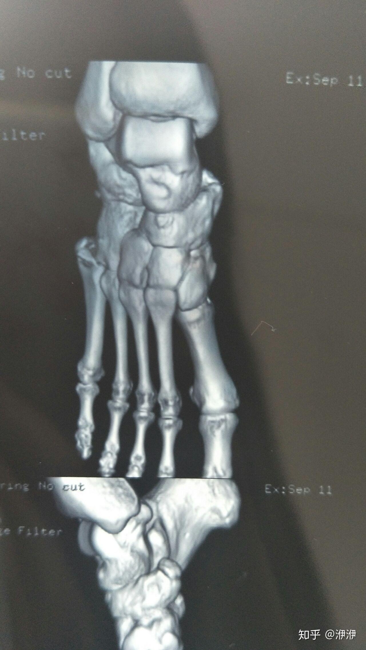 记录右脚第五跖骨骨折恢复过程