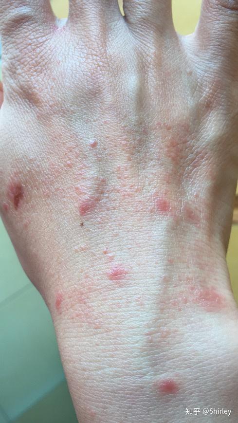 玫瑰糠疹湿疹紫外线灯灼伤之痛苦经历