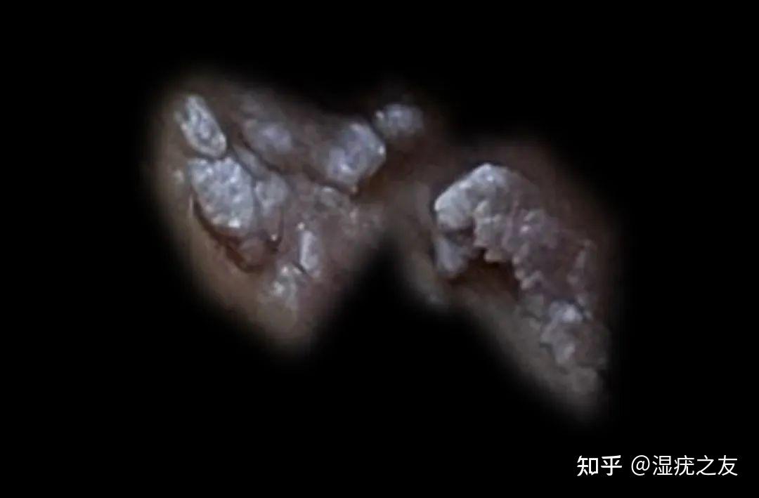 下体长疙瘩不痛不痒,会是尖锐湿疣吗?(内附图)