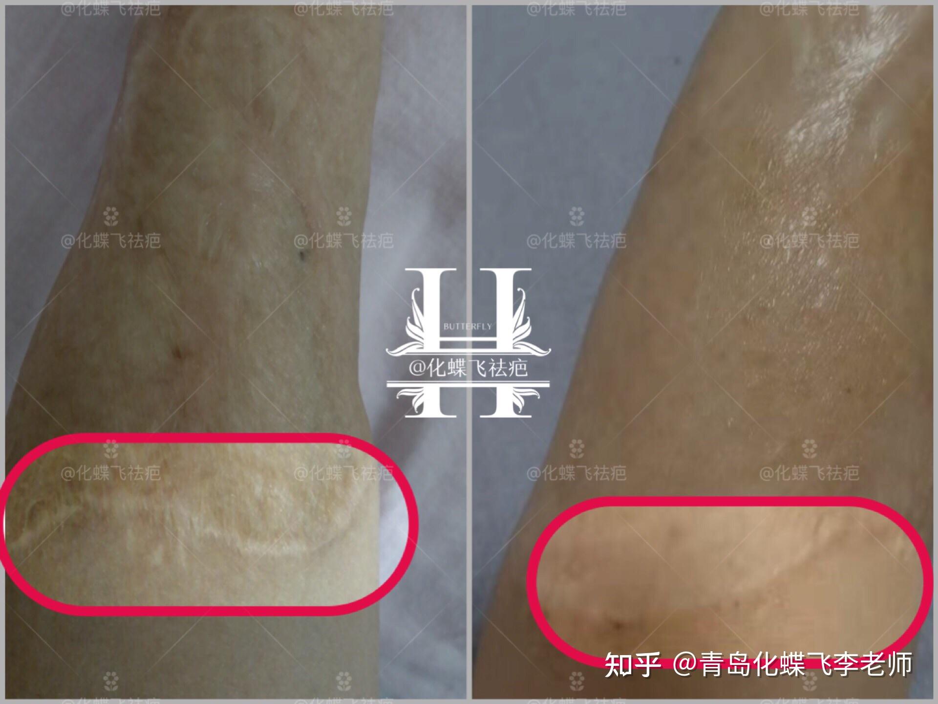 植皮手术疤痕修复对比 - 知乎