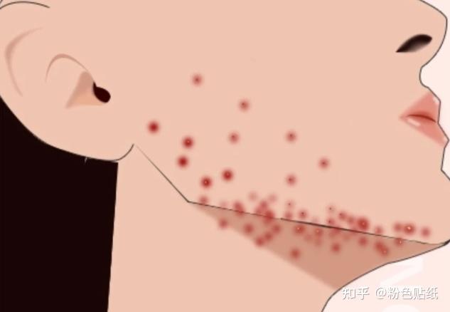 腮边痘反反复复看过来 - 知乎