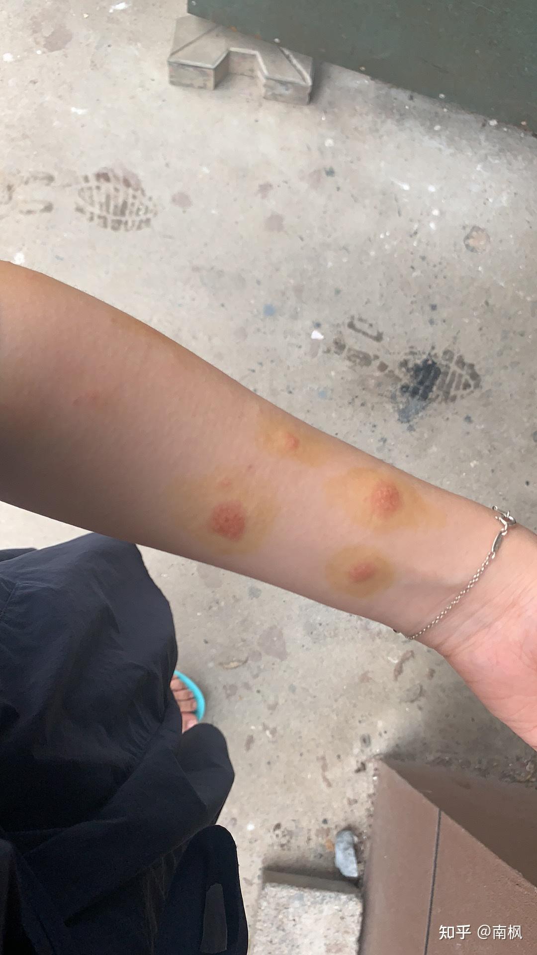 丘疹型寻麻疹痊愈过程分享