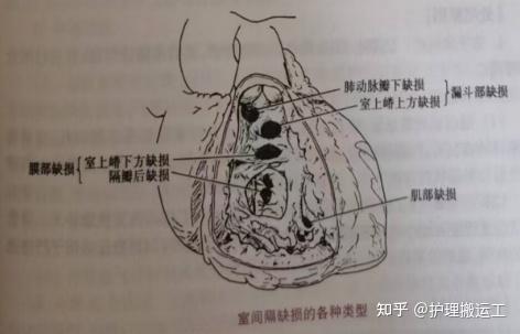 室间隔缺损基础知识 - 知乎