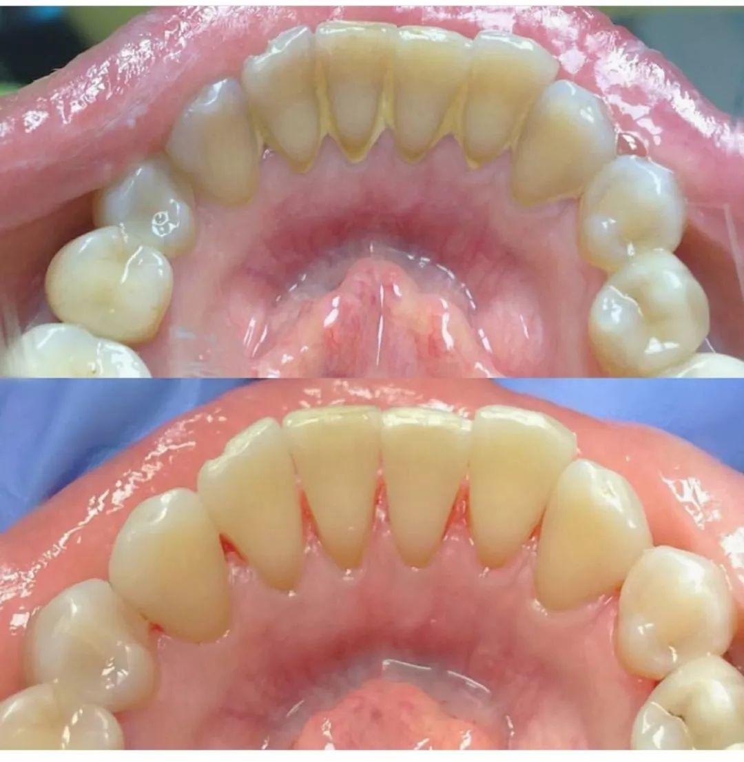 文山牙齿矫正|早期矫治案例 门牙及时“扭转回正” - 知乎