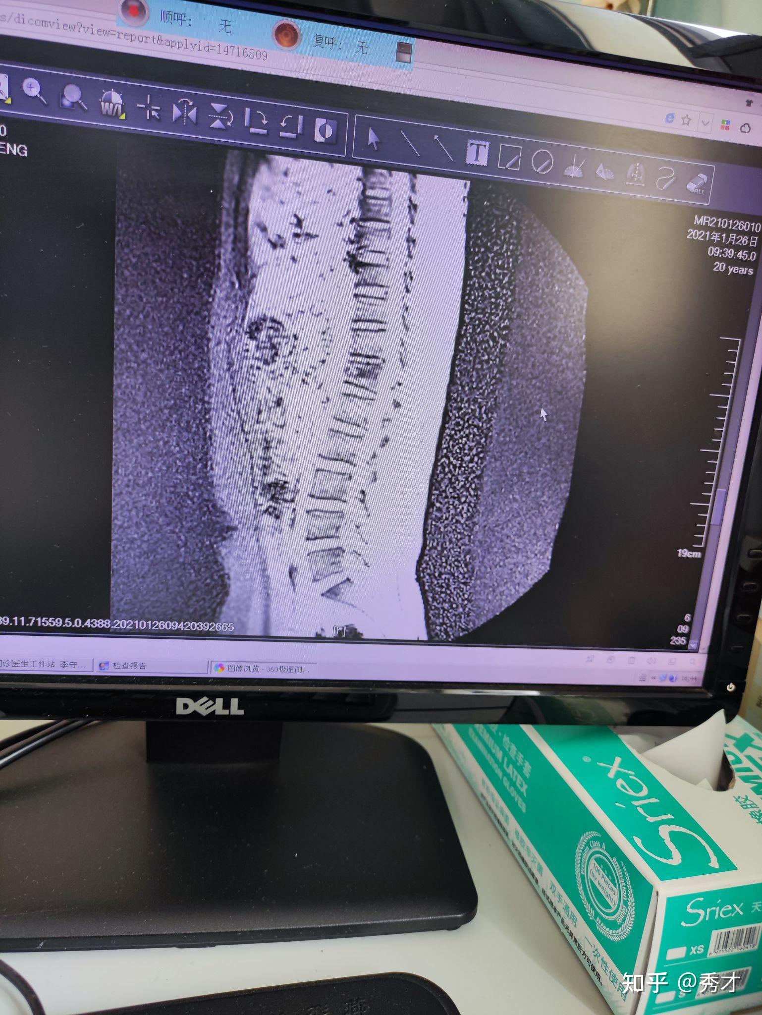 胸12椎体爆裂性骨折图片