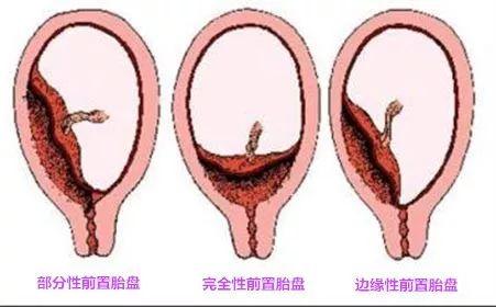 膜状胎盘图片