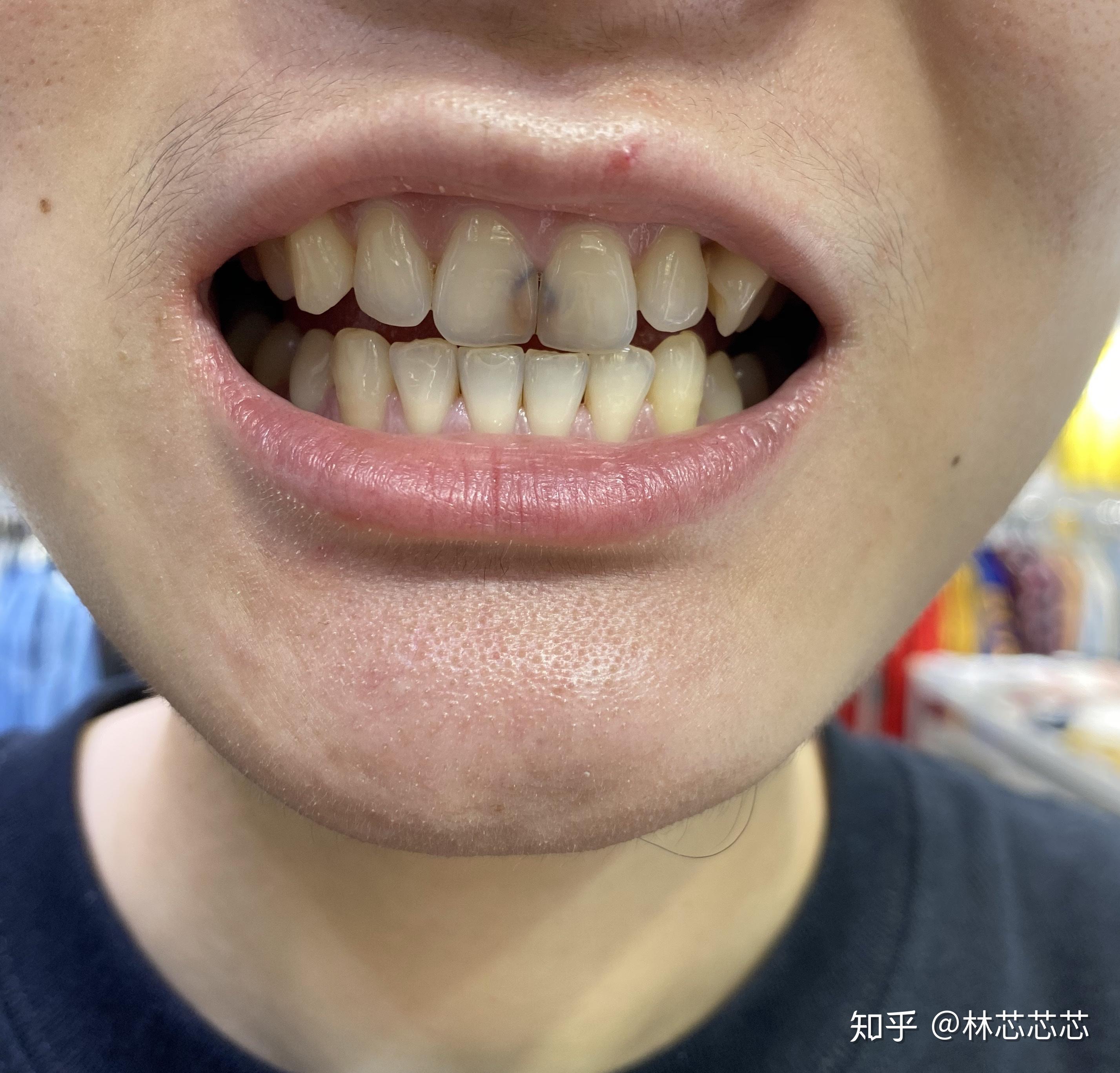 难看的黑门牙侧面龋发展到牙髓炎