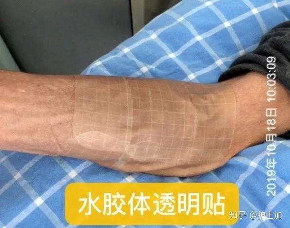 蔗糖铁外渗竟有如此严重下一步该怎么办