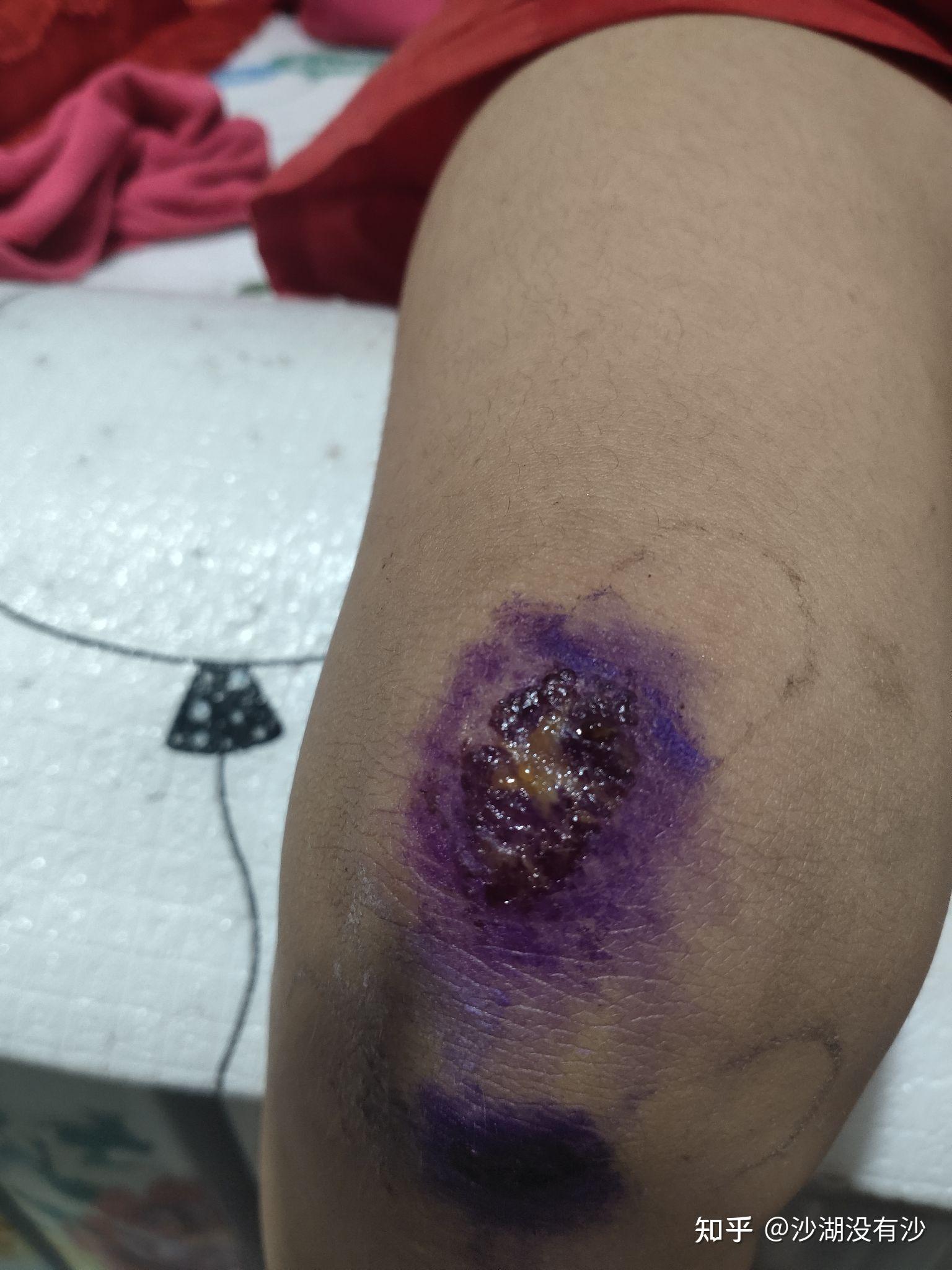 腿跌坏了有点腐烂怎么办