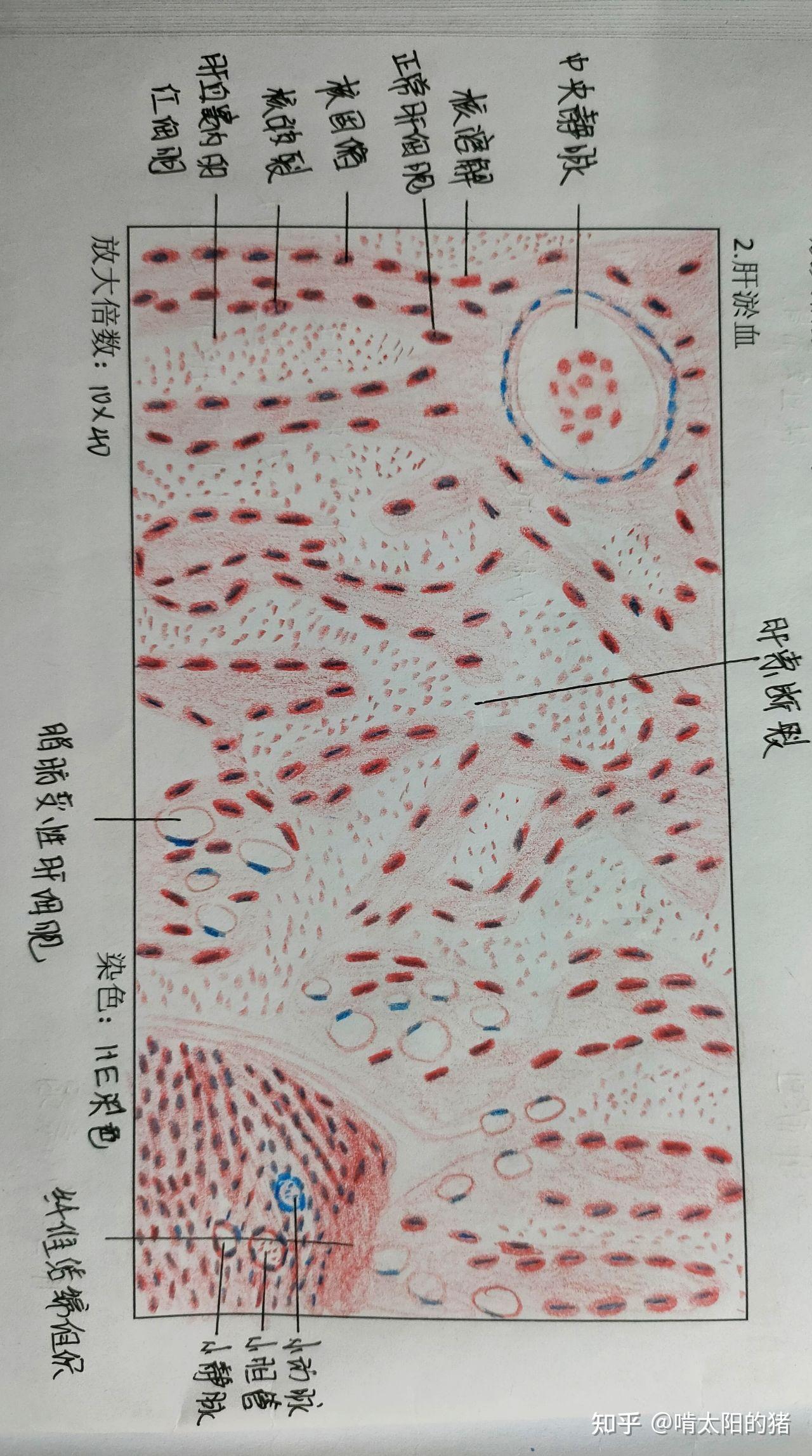 横纹肌肉瘤红蓝铅笔图图片
