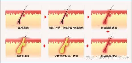 头皮越挠越痒?找到根源搞定头痒难题! - 知乎