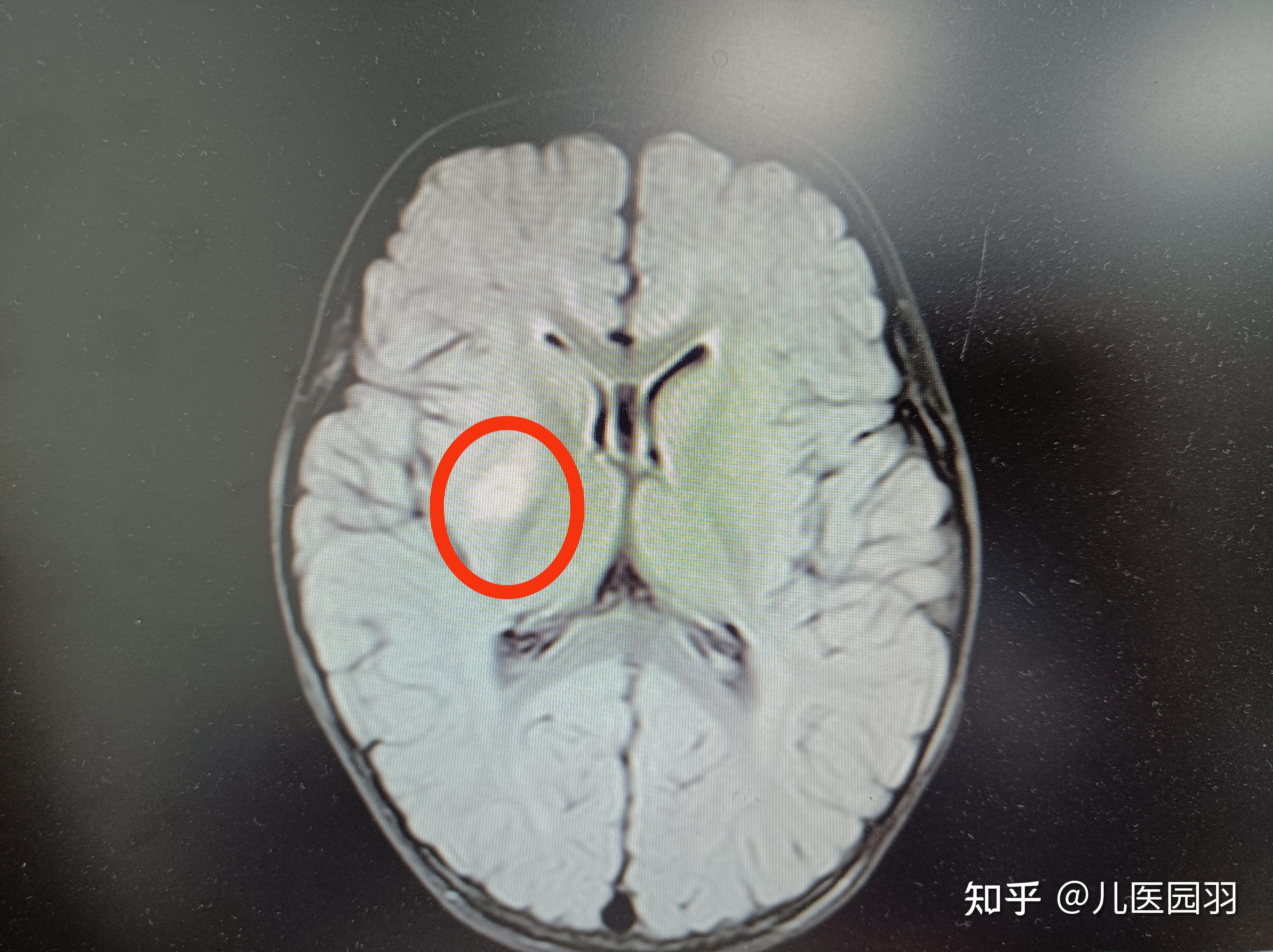 脑（脑卒中、脑肿瘤、脑梗死、脑内出血）（医疗、保健、科学背景）（脑交叉部分）的膜MRi（磁共振成像） )高清摄影大图-千库网