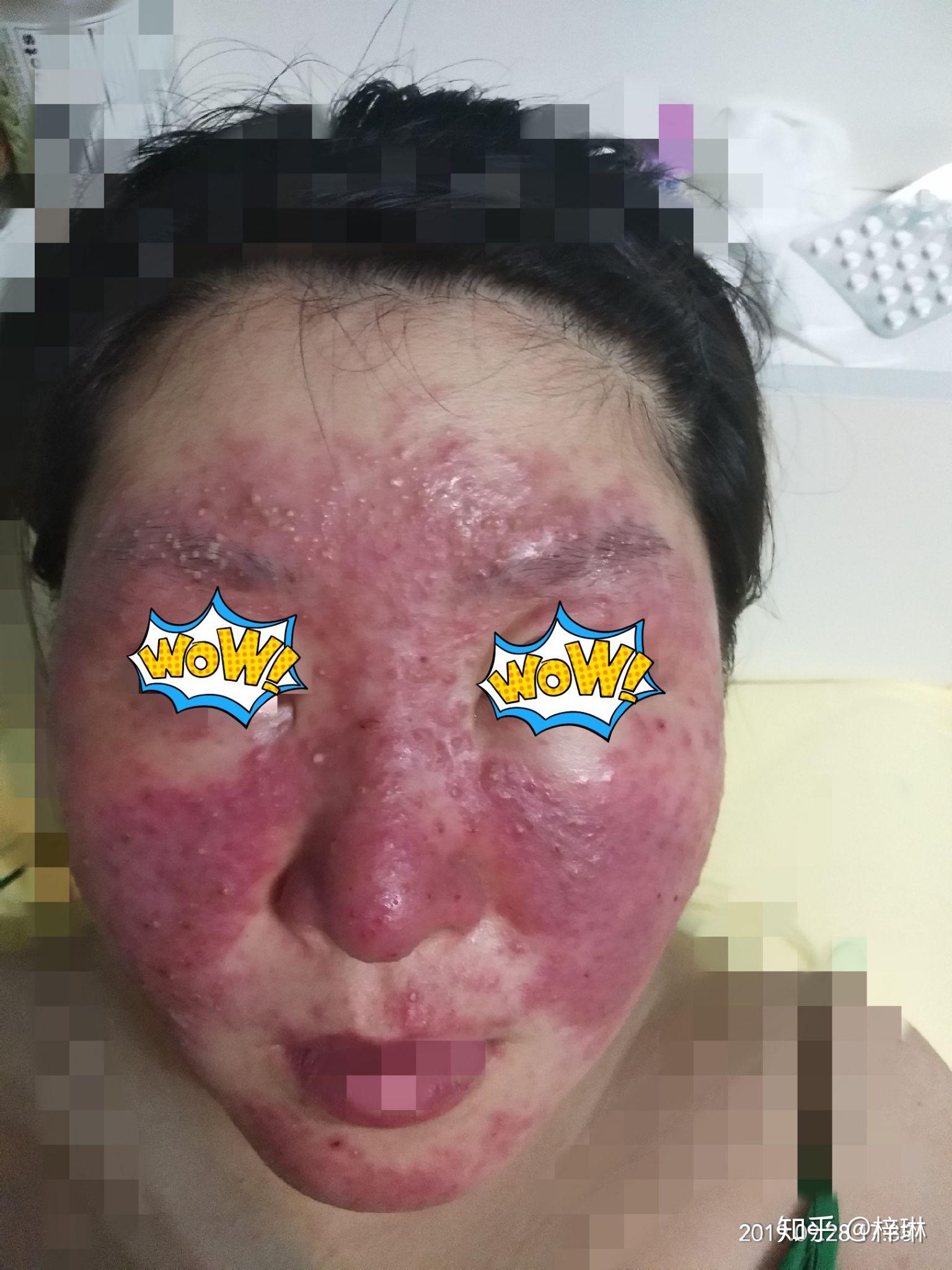 激素脸吗红肿变形得多久能好