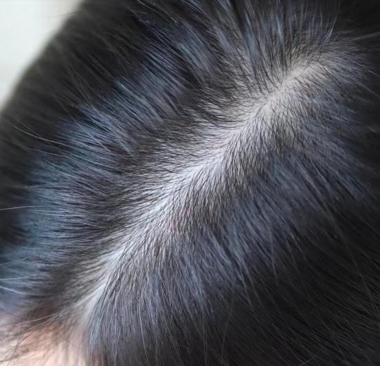 头皮干燥头皮屑越来越多怎么办被问了1000遍的去头皮