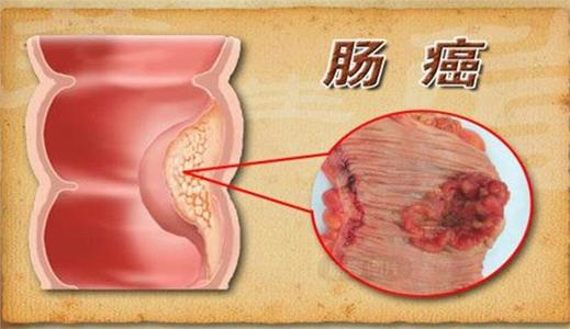 大腸癌高危險群 請加做大腸鏡大腸癌高風險人群:1.五十歲以上2.