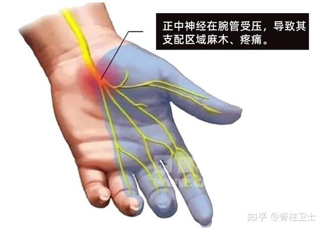 手麻是什么原因123? - 知乎