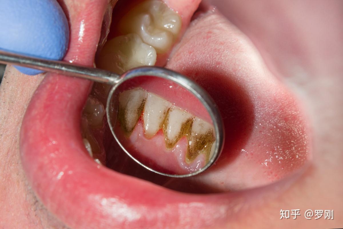 什么是牙龈炎牙周炎图片素材-编号19219770-图行天下