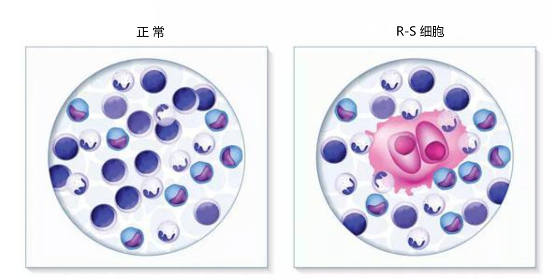 经典霍奇金淋巴瘤(classical hodgkins lymphoma,chl)是一种淋巴细胞