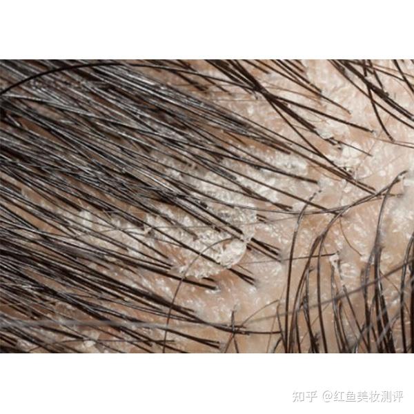 为什么孩子头上长头皮屑？真相揭秘！?头皮享受深层清洁 - 知乎