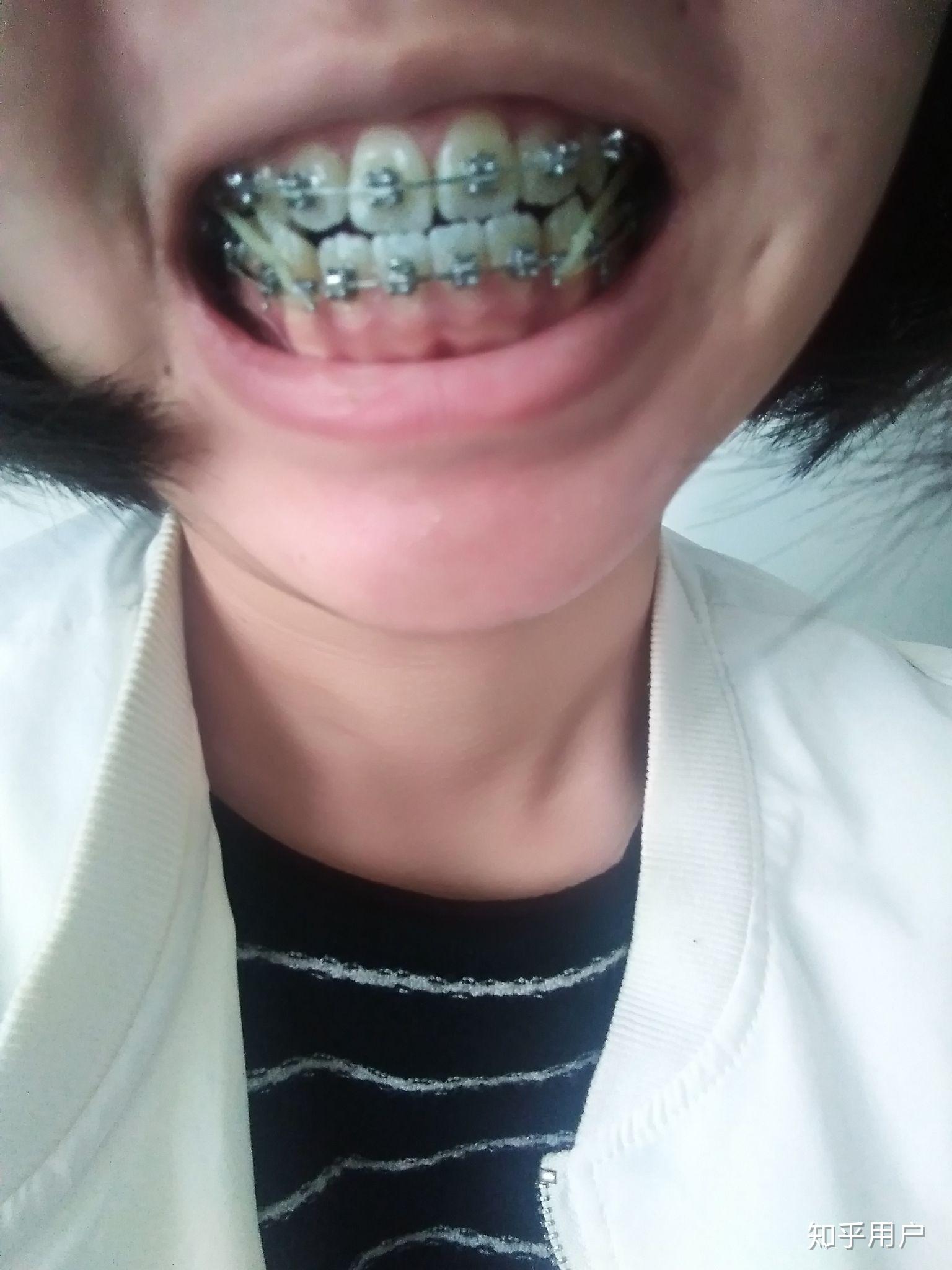 超复杂案例｜骨性反颌、多颗牙缺失、乳牙滞留、畸形牙...怎么处理？！ - 知乎