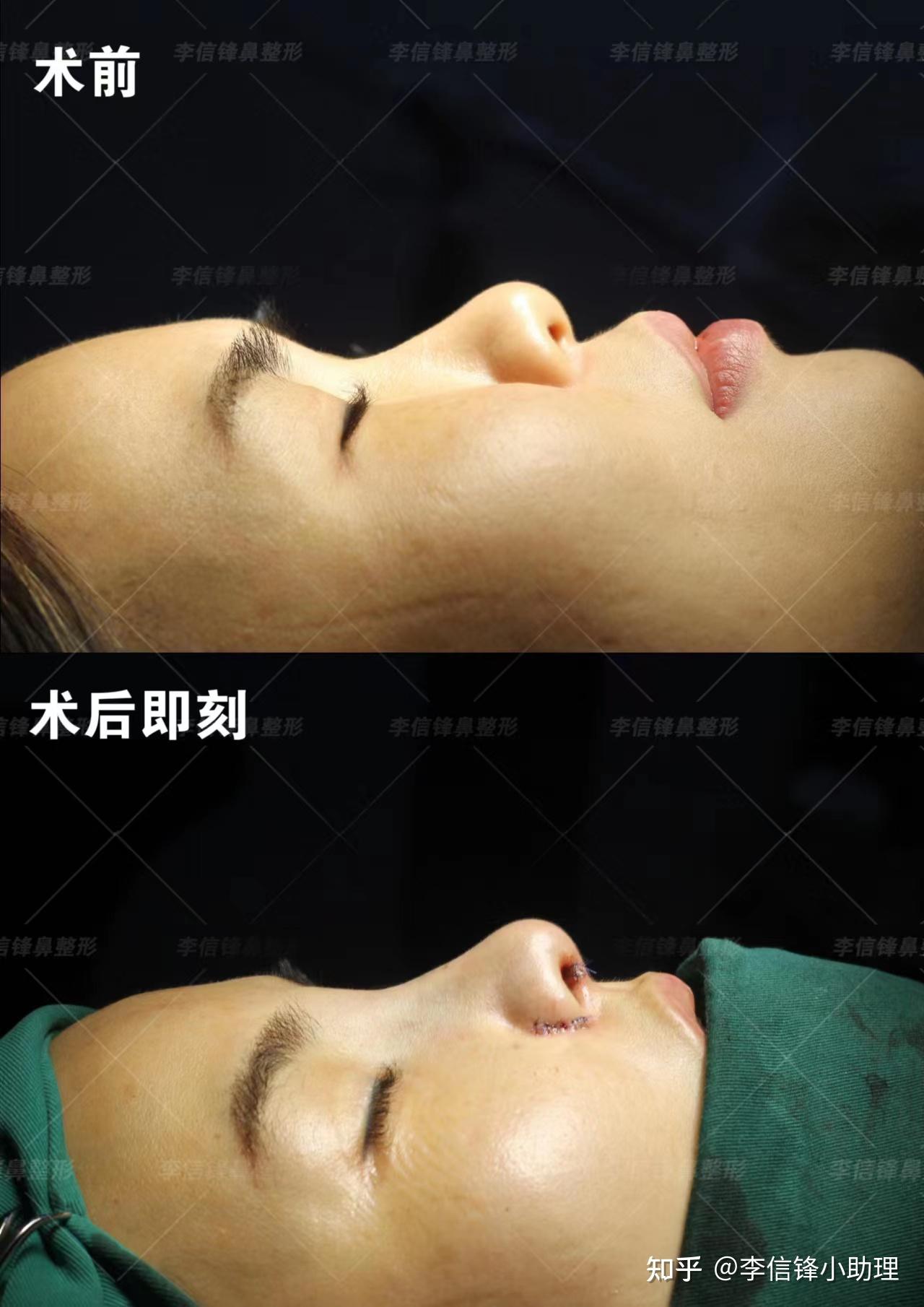鼻翼缩小整容多少钱_通过整容缩小鼻翼和鼻头_整容缩小鼻子