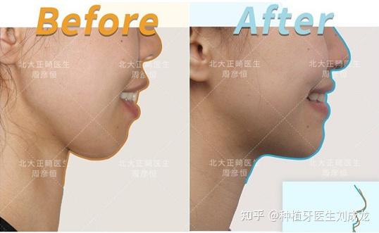 郑州牙齿矫正:上颌前突,下颌后缩,前牙深覆合矫治,精致的下巴,换头一