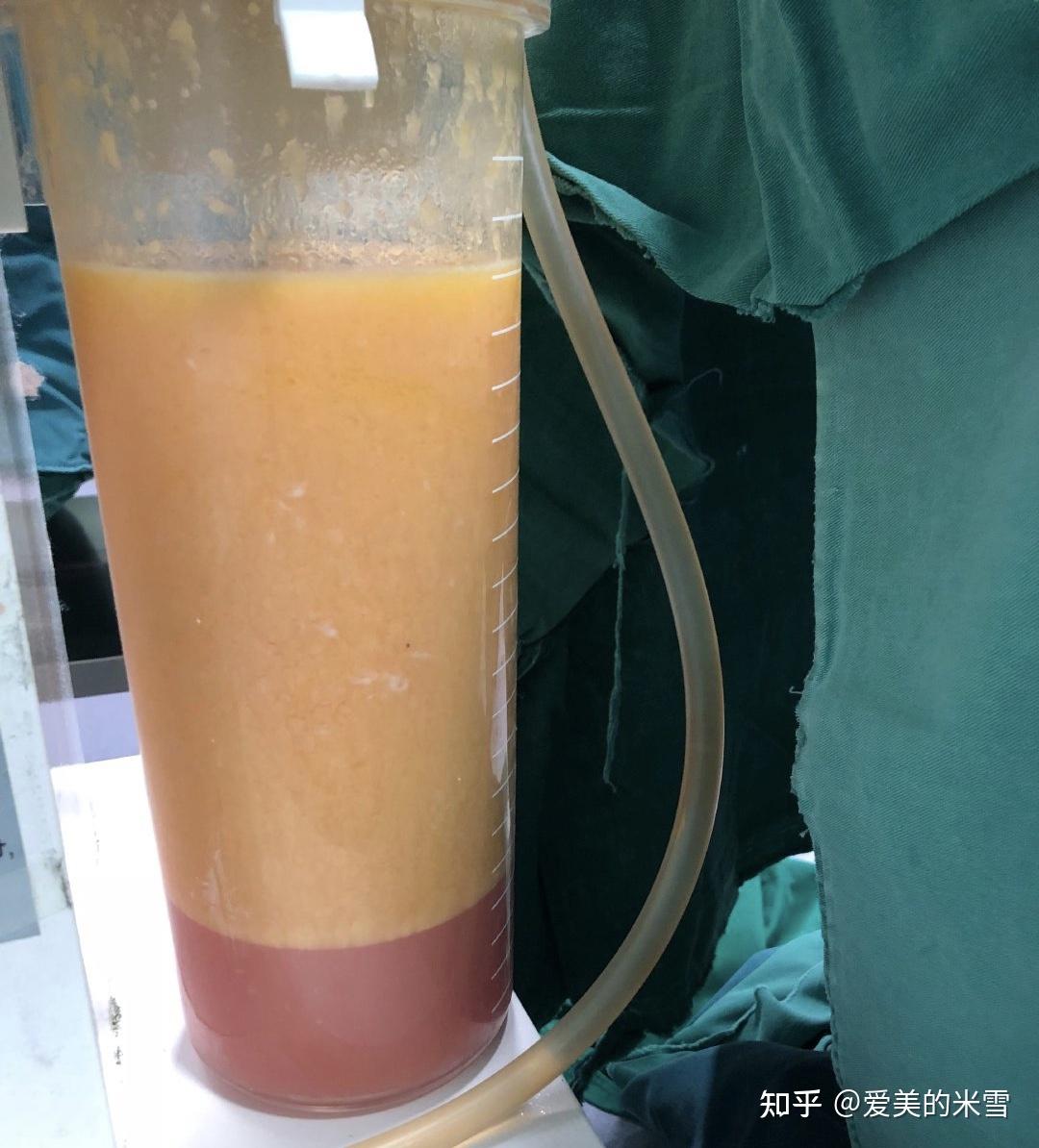 超脂塑吸脂是什么原理和威塑有什么区别哪个好哪些机构有正版设备能做