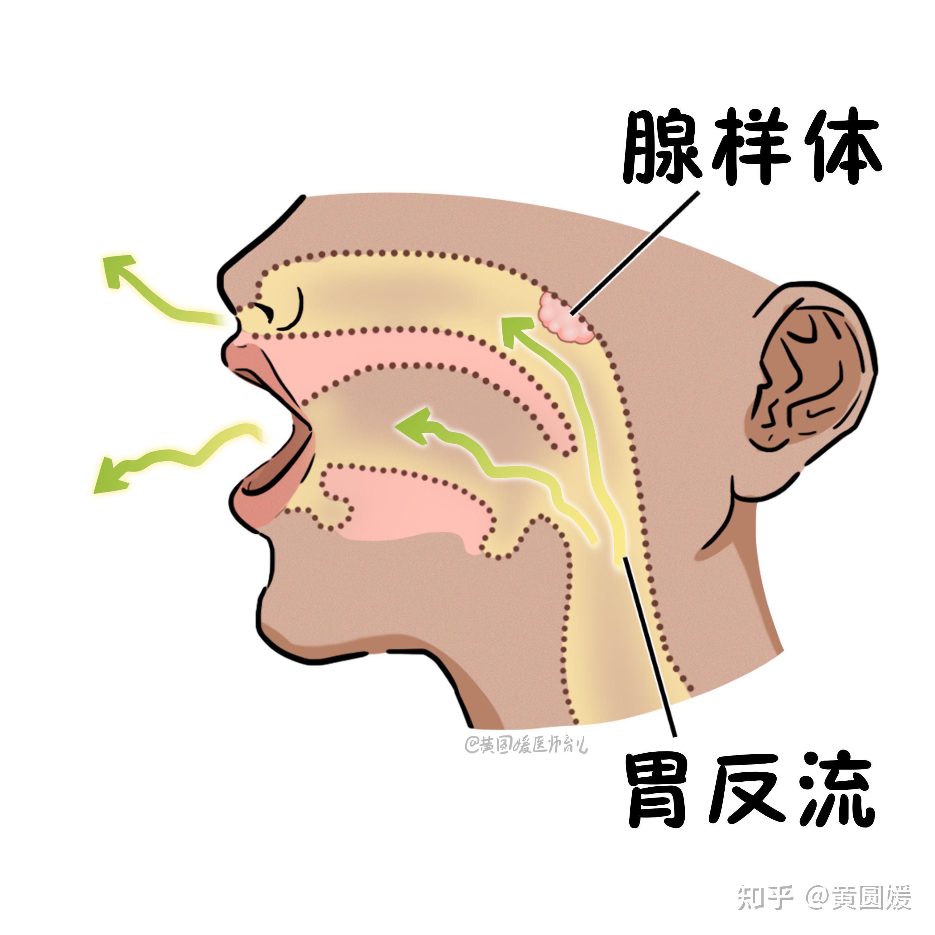 腺樣體肥大扁桃體發炎避免復發這兩個檢測一定要做