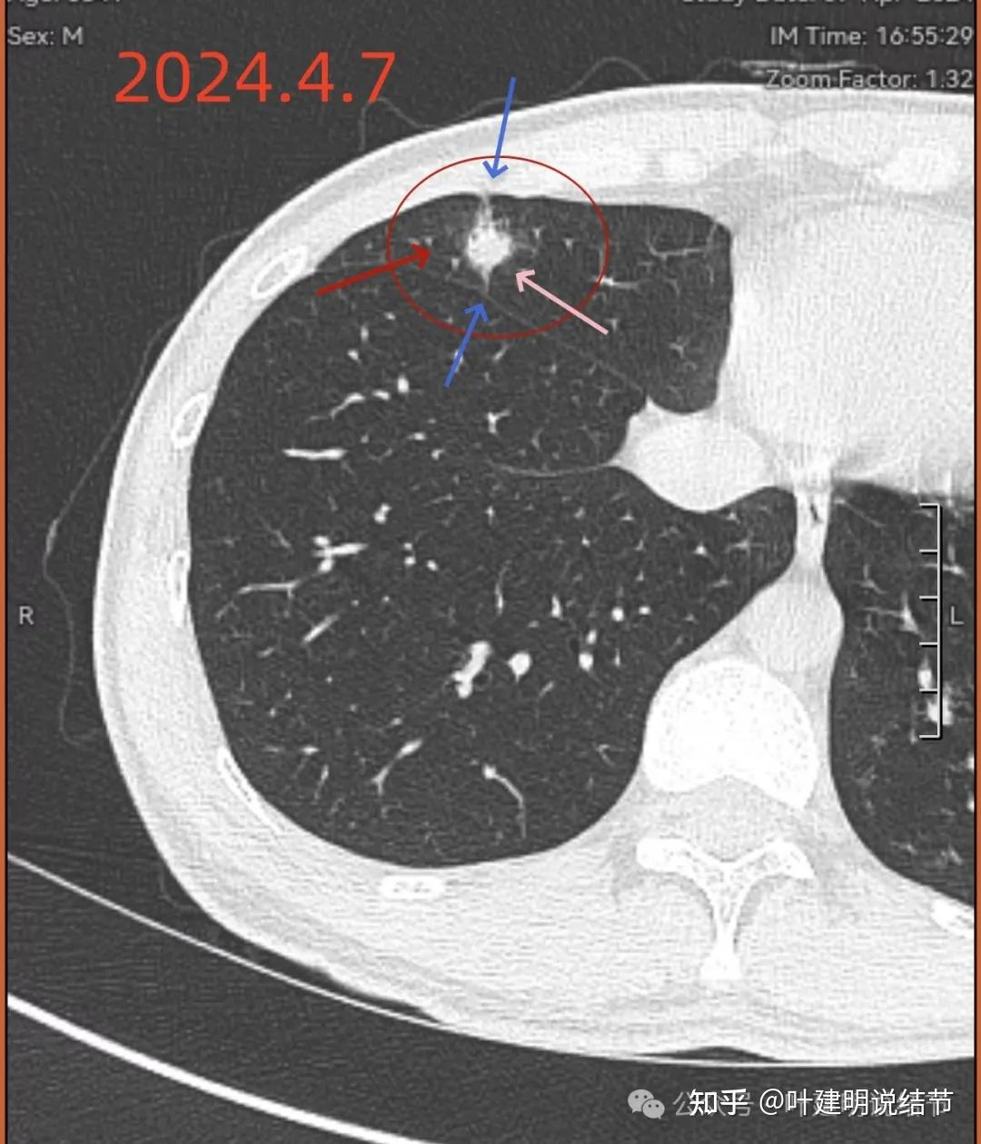 肺结节大小图片