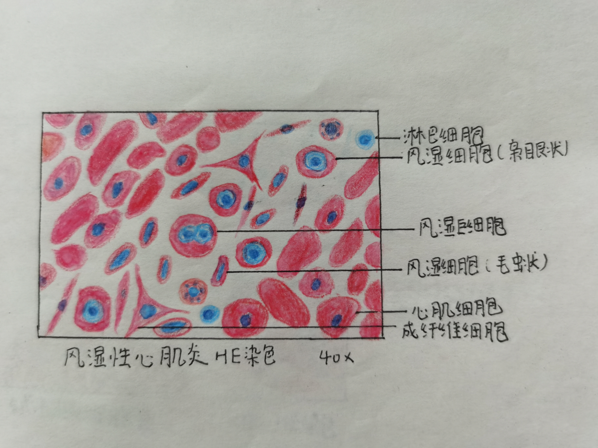 化脓性脑膜炎红蓝绘图图片