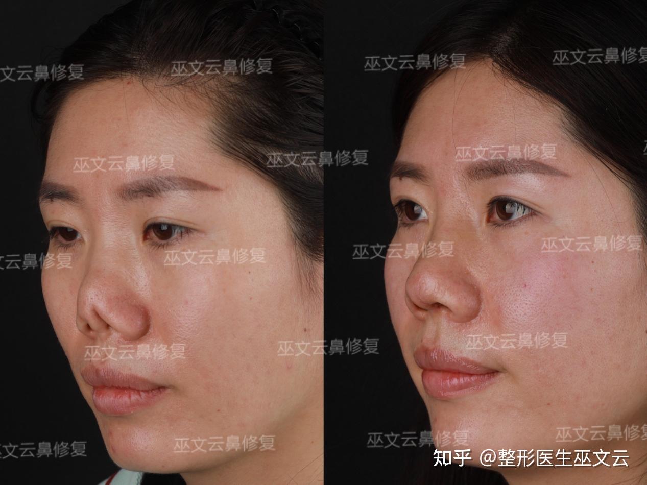 巫文云挛缩鼻修复集锦技术和审美都很重要