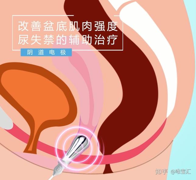 盆底肌电刺激治疗的原理