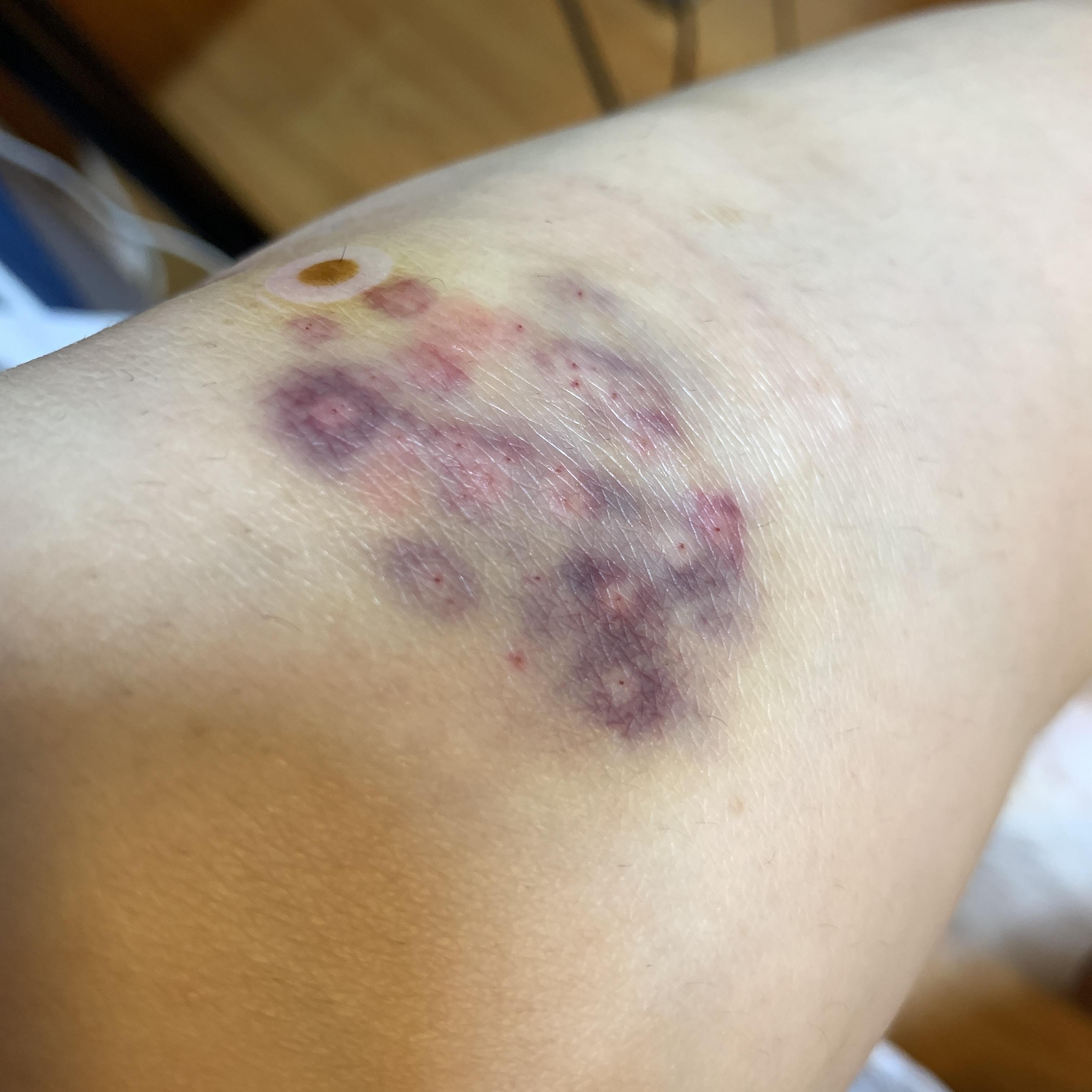 去美容院刮痧后用针在几个穴位上扎眼然后拔罐子吸出来的血都凝固了说