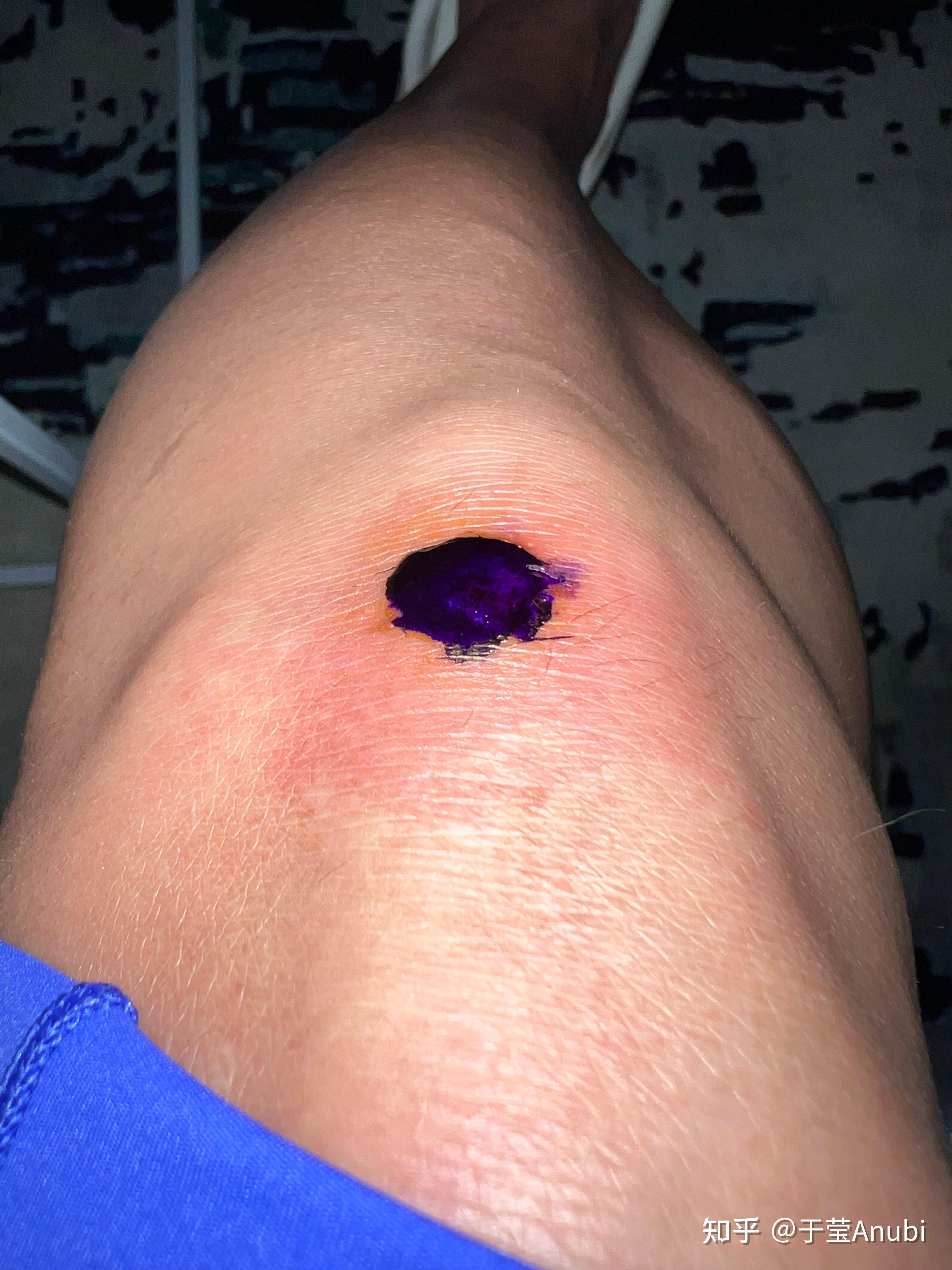 关于膝盖开放性伤口处理