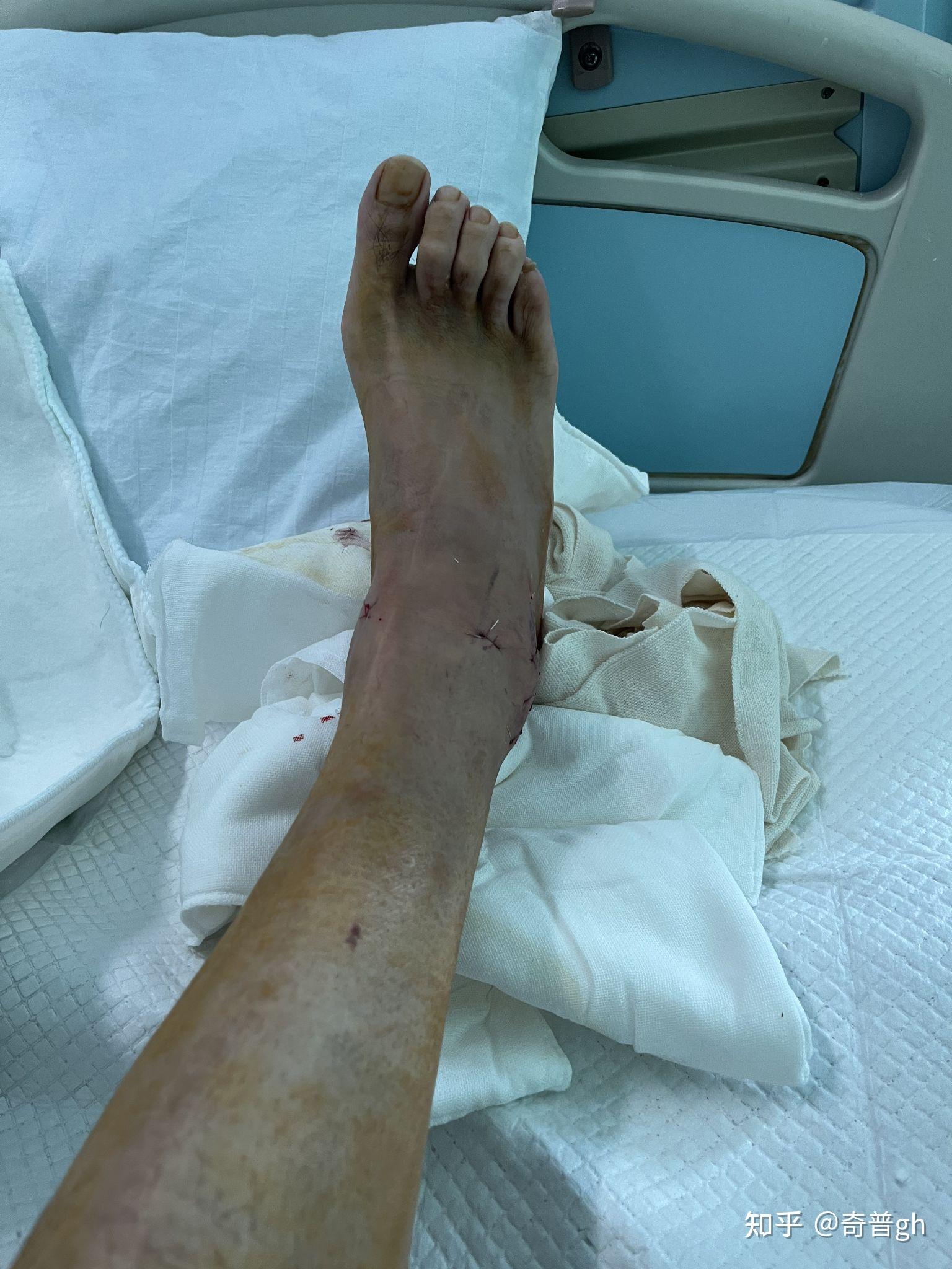 在深圳,做右脚踝距腓前韧带断裂修复手术记录哈哈(巨详细)