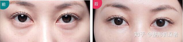 有没有做过眼部抽脂的前后对比图