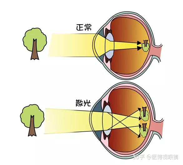 你真的了解散光吗